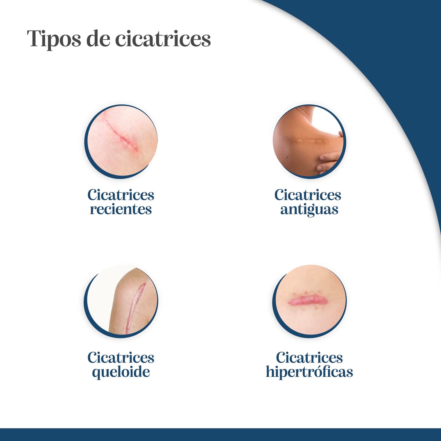 Trofolastin, Reductor de Cicatrices Mamario, Apósitos Adhesivos para Cicatrices de Cirugía Mamaria, Hipertróficas y Queloides, 3 Formatos x 2uds